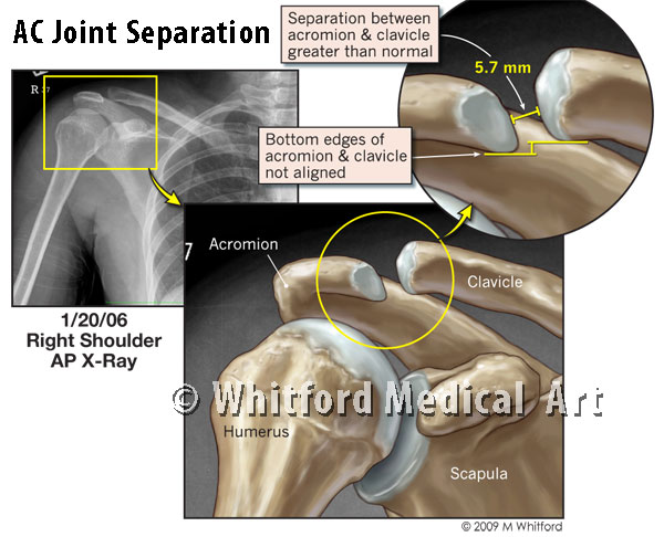 Medical legal illustration shoulder separation