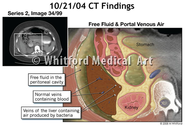 Medical legal illustration of CT image