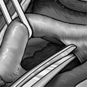 Medical illustration AV fistula surgery thumbnail