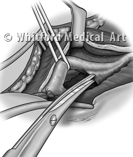 Medical illustration AV fistula surgery