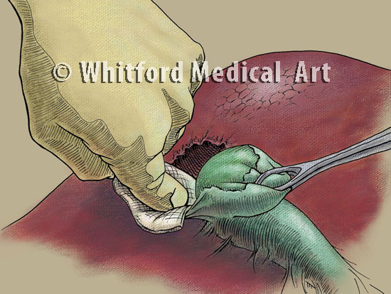 Medical illustration cholecystectomy surgery