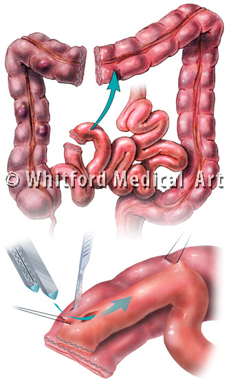 medical illustration colectomy surgery bowel resection