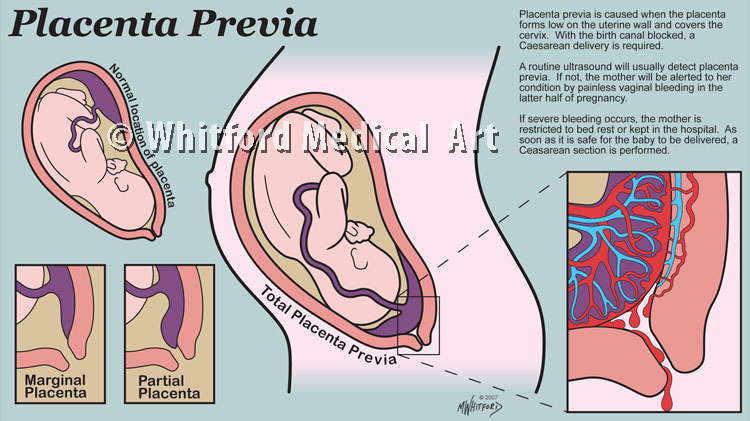 Medical illustration placenta previa infographic patient education
