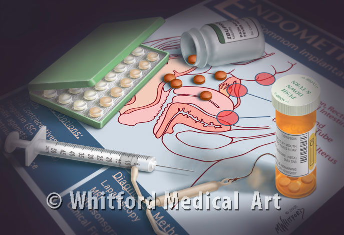 Medical illustration endometriosis treatments patient education